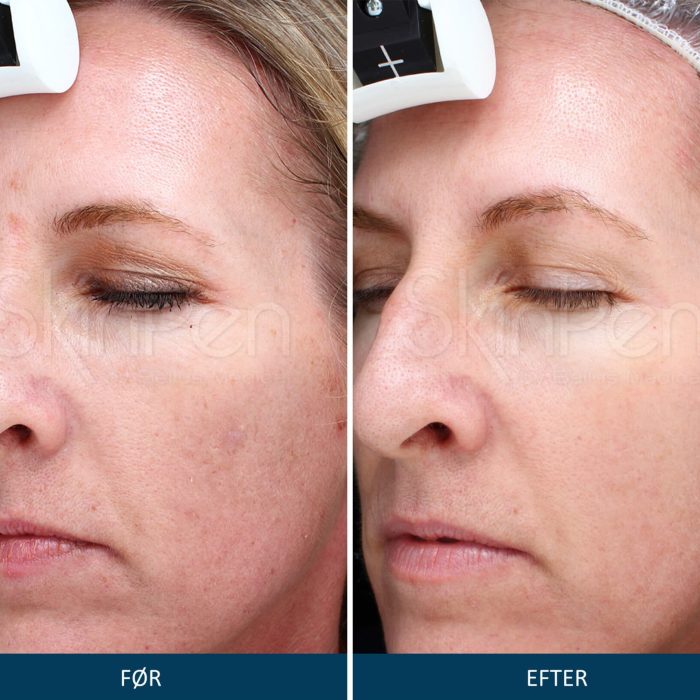 Microneedling SkinPen før og efter 2