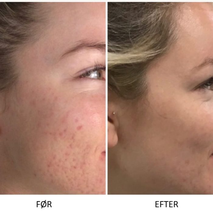 Microneedling SkinPen før og efter 10