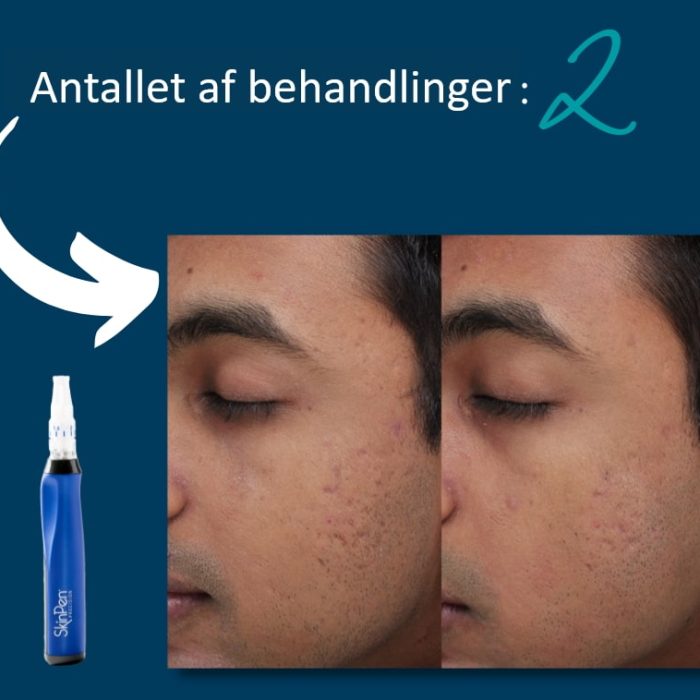 Microneedling SkinPen før og efter 11