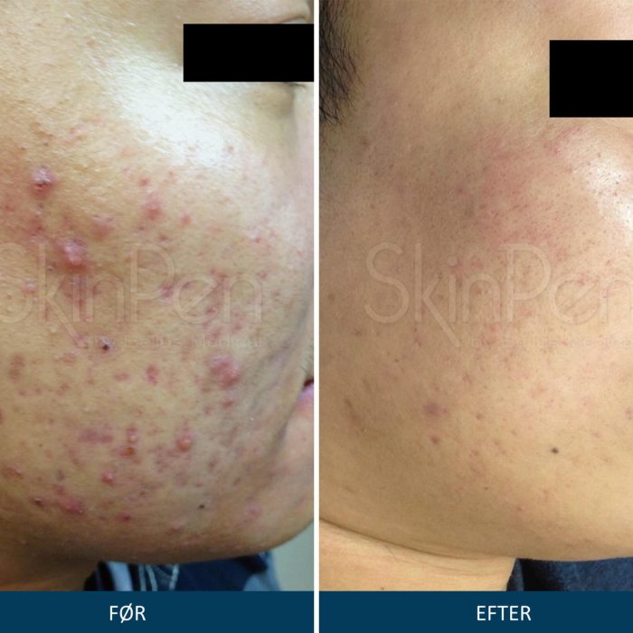 Microneedling SkinPen før og efter 3