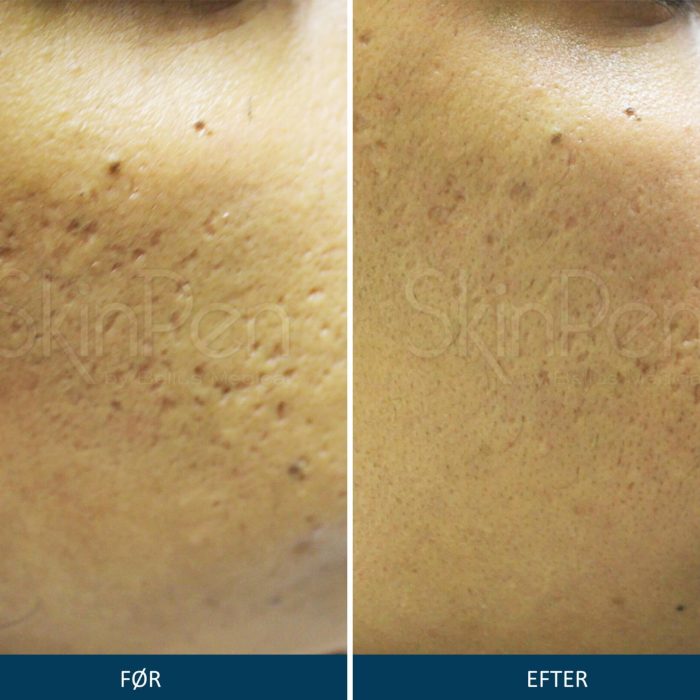 Microneedling SkinPen før og efter 4
