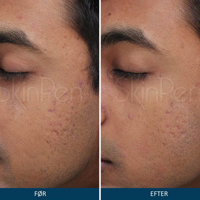 Microneedling SkinPen før og efter 5