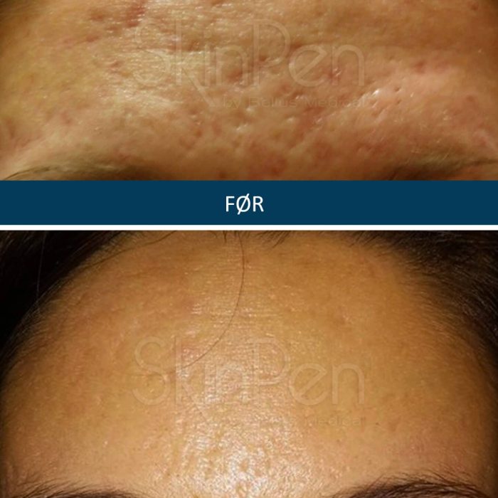 Microneedling SkinPen før og efter 6