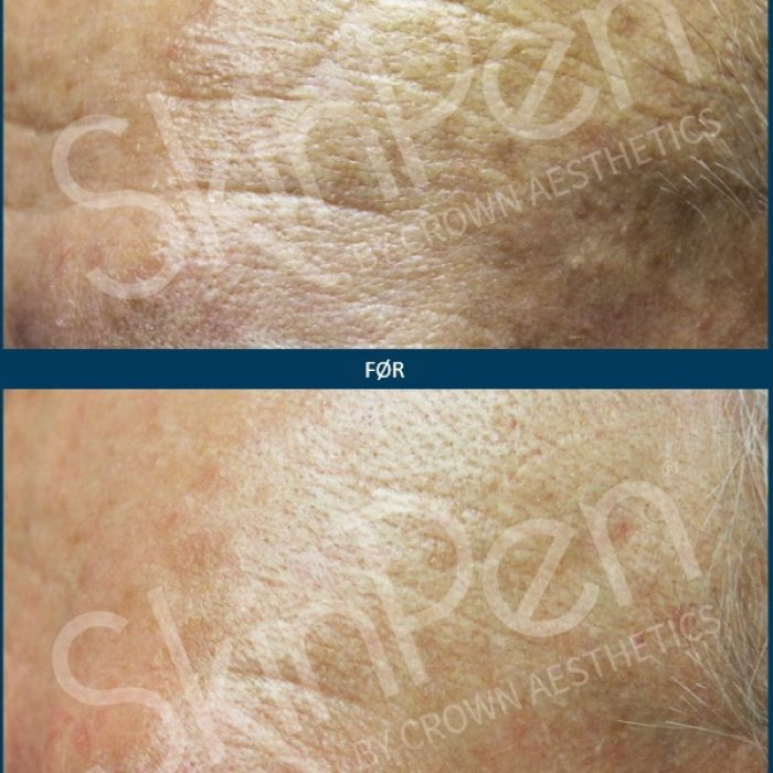 Microneedling SkinPen før og efter 8