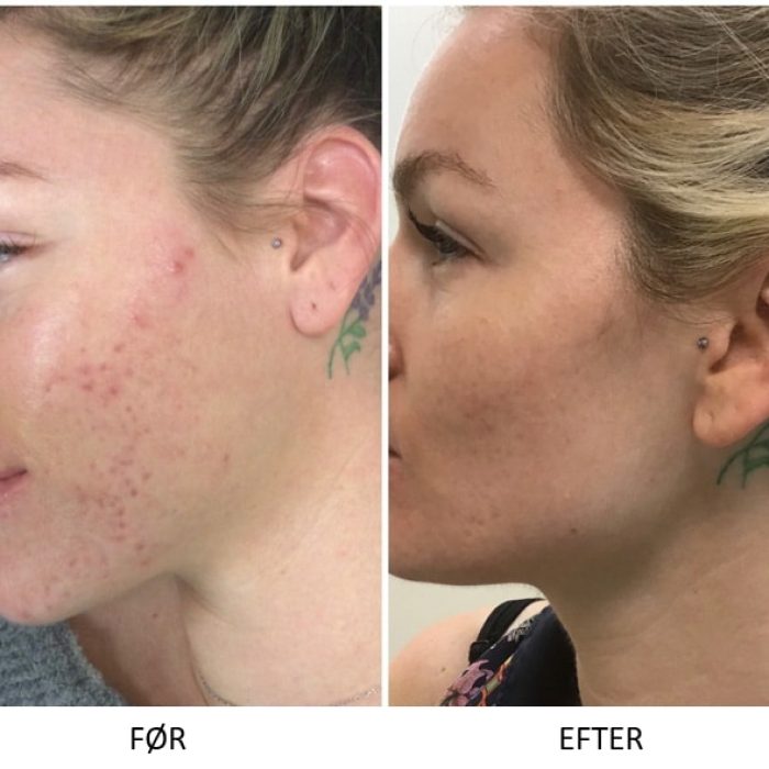 Microneedling SkinPen før og efter 9