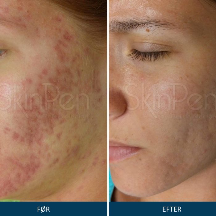 Microneedling SkinPen før og efter
